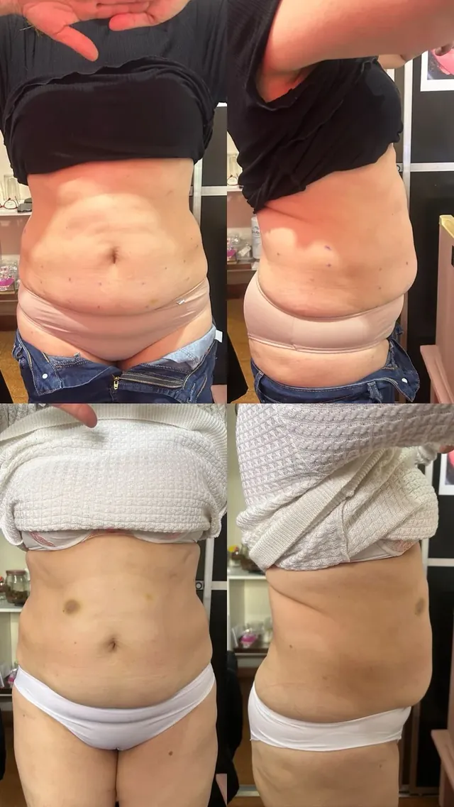 Antes e depois de redução de medidas no abdômen