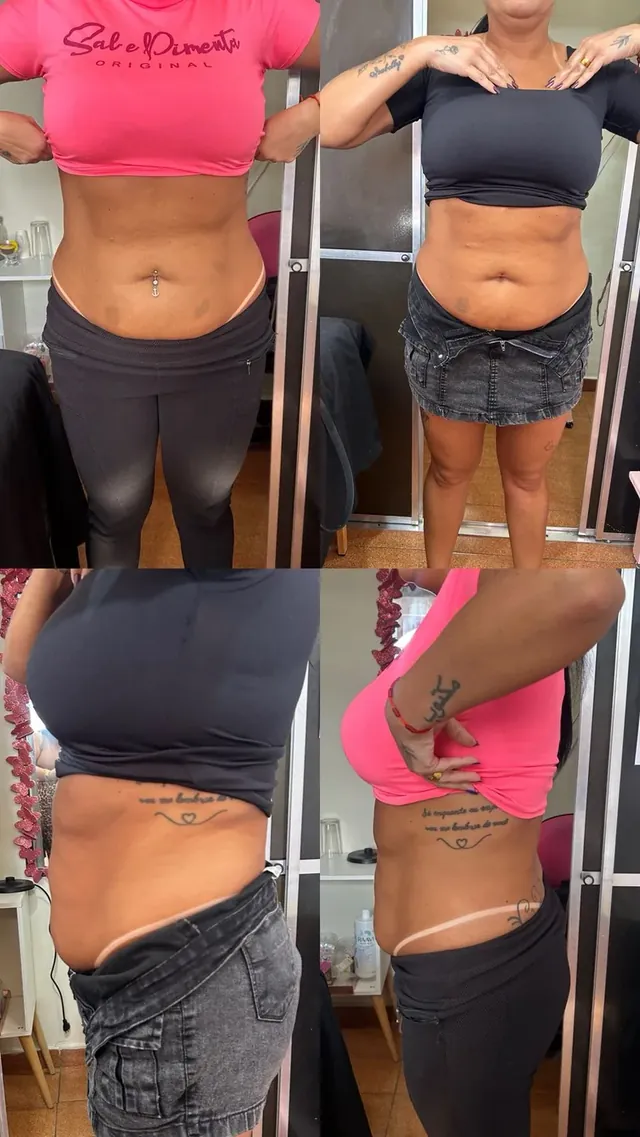 Antes e depois de redução de medidas no abdômen