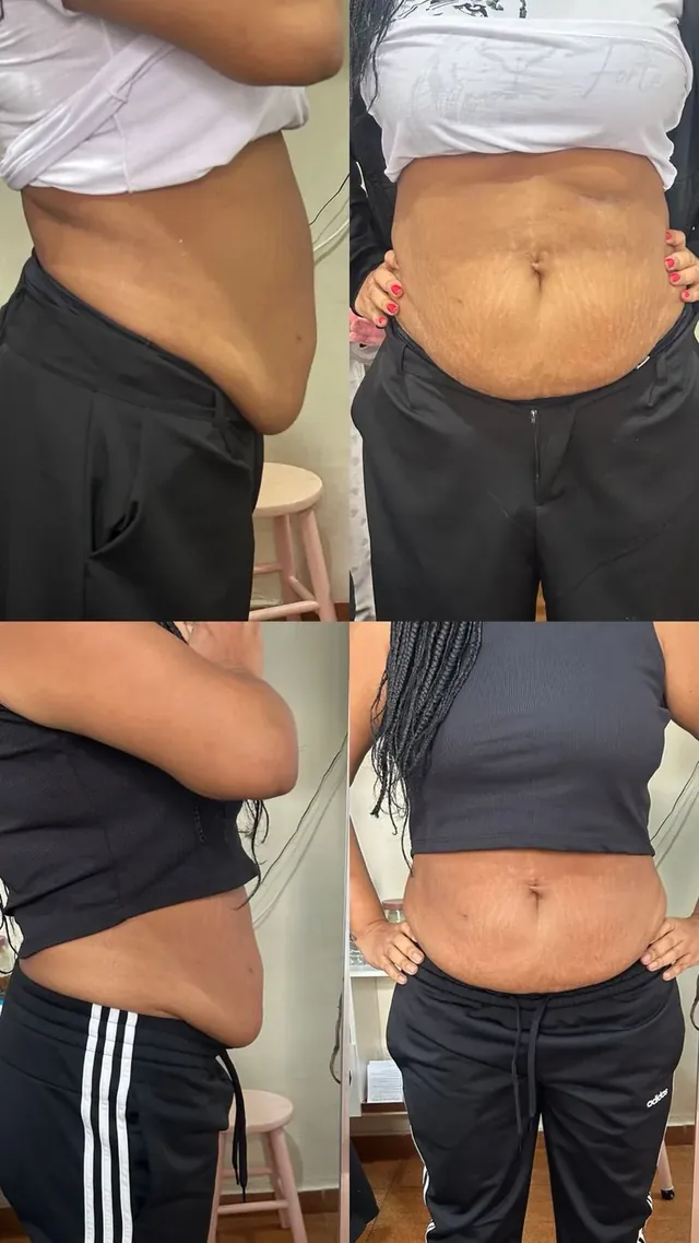 Antes e depois de redução de medidas no abdômen