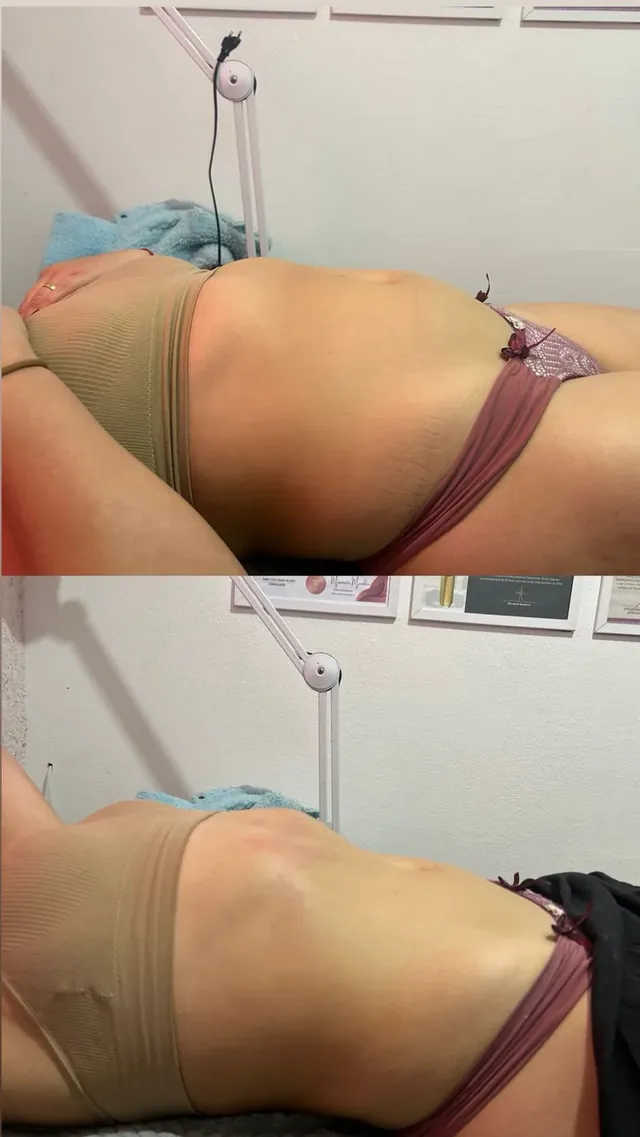 Antes e depois de massagem modeladora