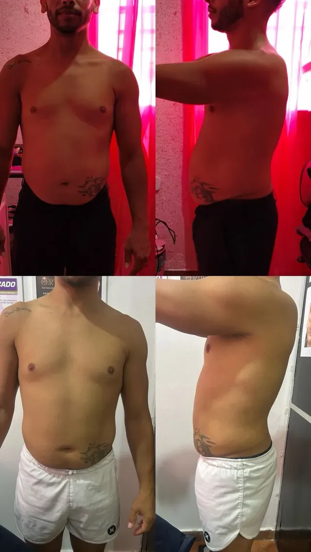 Antes e depois de redução de medidas no abdômen