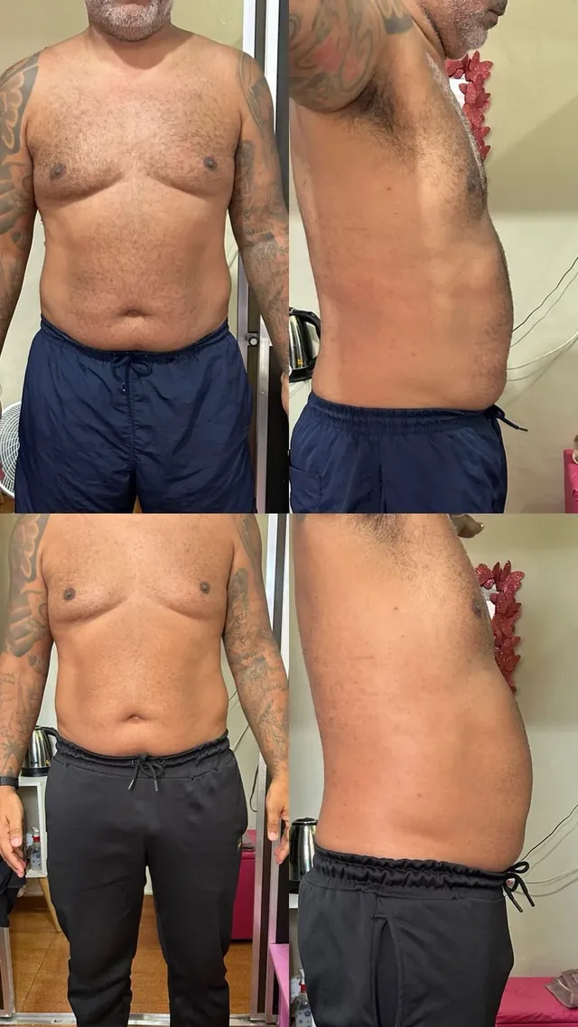 Antes e depois de redução de medidas no abdômen