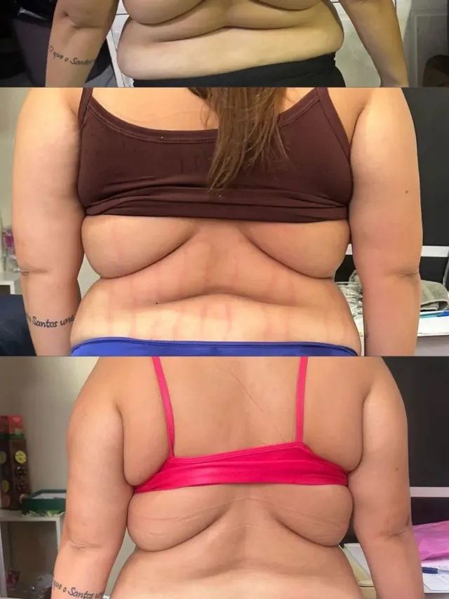 Antes e depois de massagem modeladora