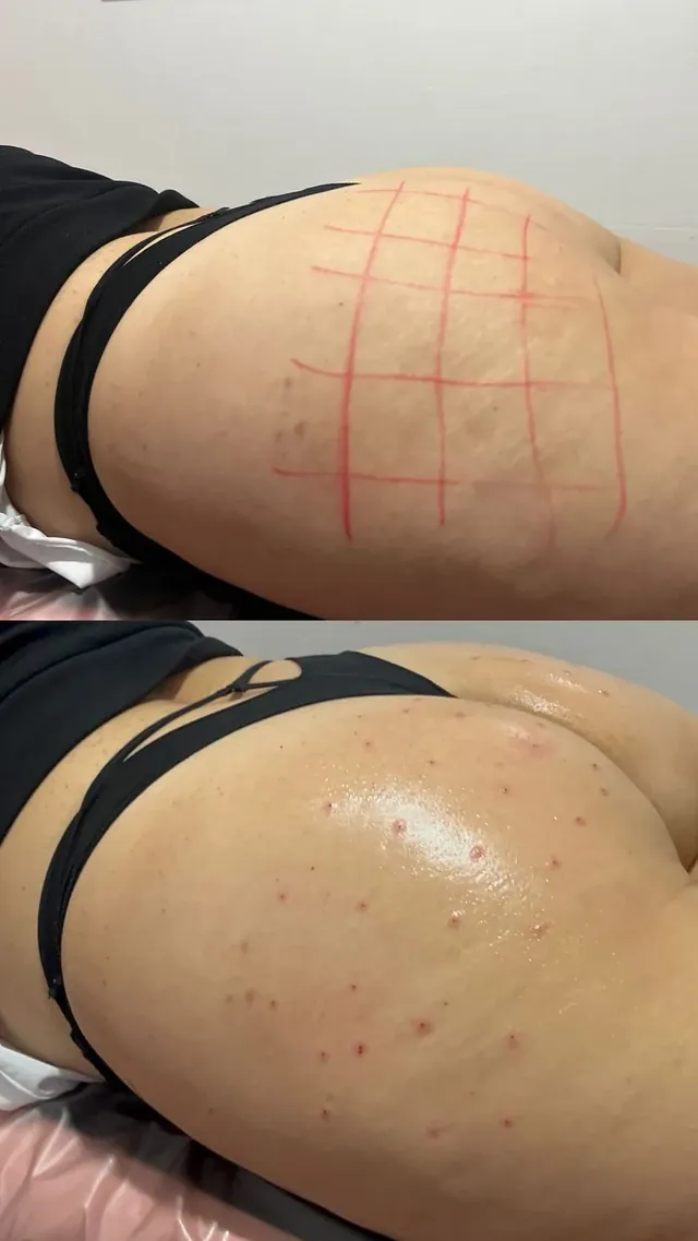 Antes e depois de lipo enzimática no glúteo