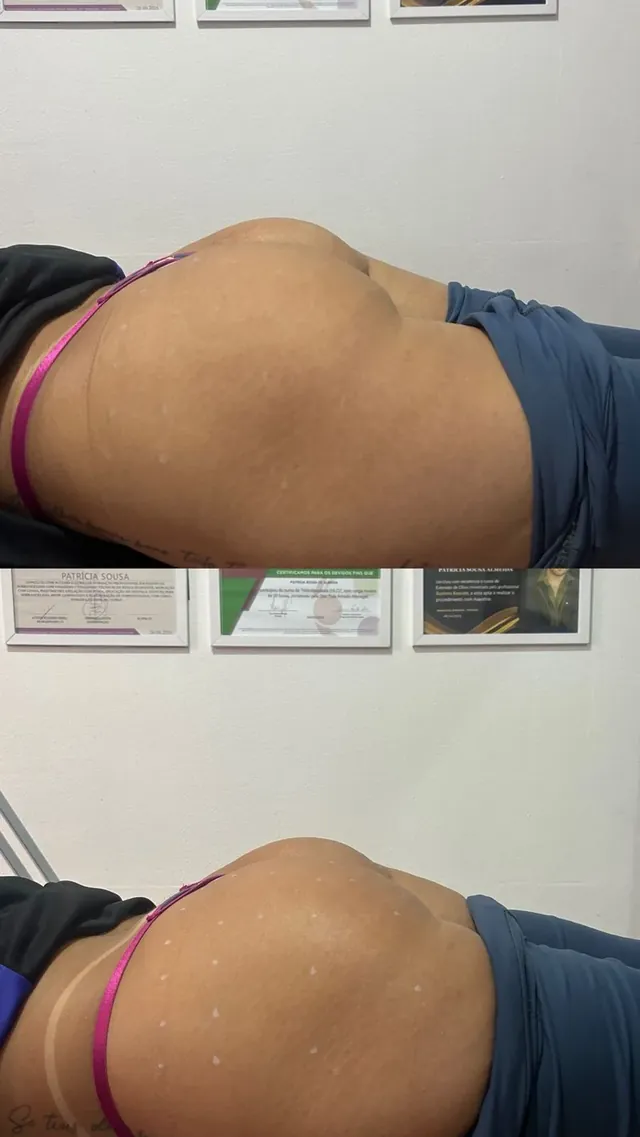 Antes e depois de massagem modeladora no glúteo
