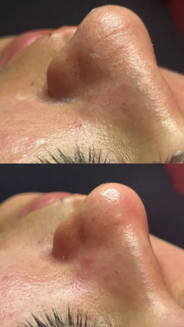 Antes e depois de limpeza de pele