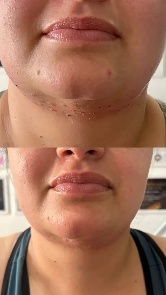 Antes e depois de tratamento de papada